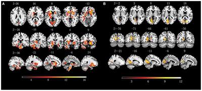 Alternations in Dynamic and Static Functional Connectivity Density in Chronic Smokers